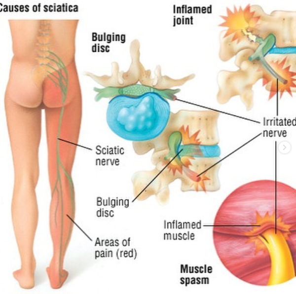 Sciatic Nerve Pain and&nbsp;Massage
